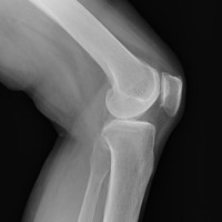 膝関節外科 スポーツ整形外科