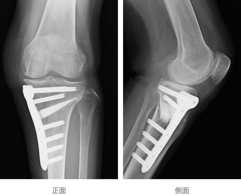 高位脛骨骨切り術