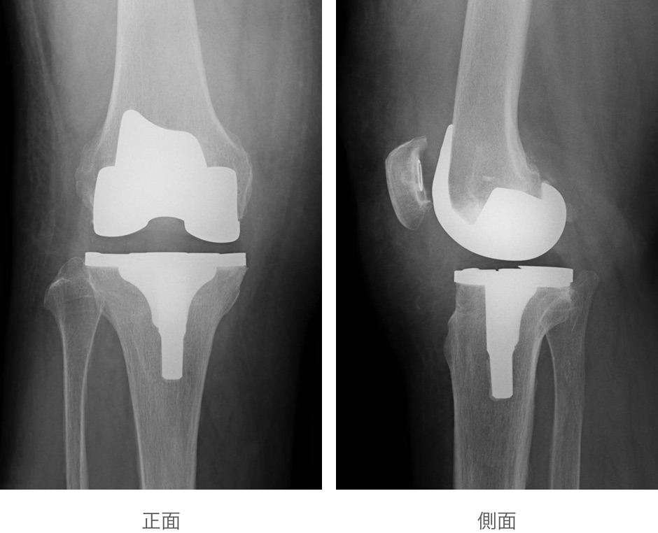 全人工膝関節置換術