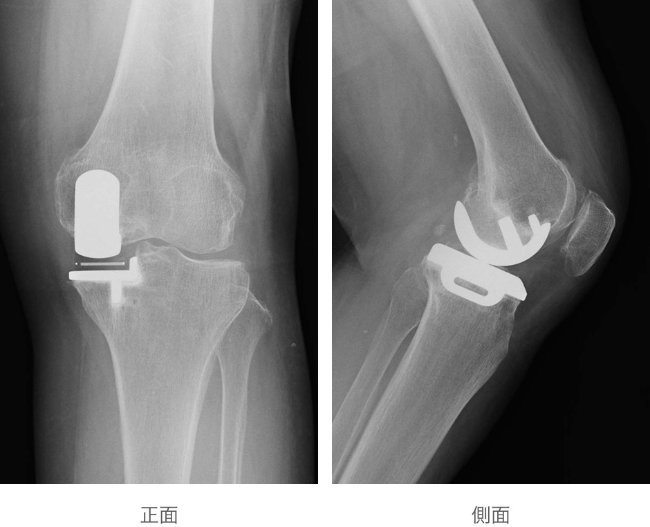 単顆型人工膝関節置換術