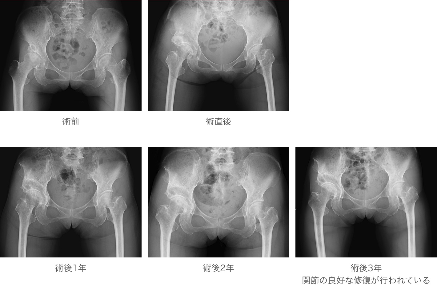 臼蓋回転骨切り術