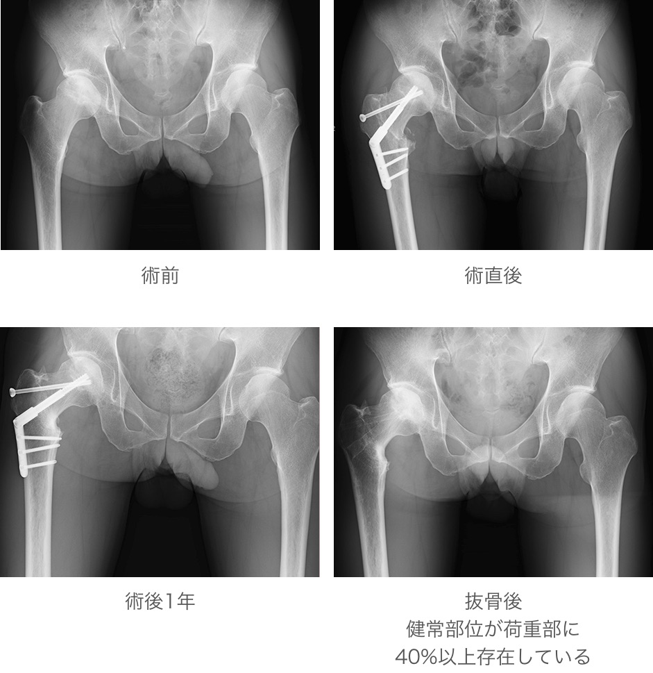 大腿骨転子間弯曲内反骨切り術（大腿骨頭壊死に対して）