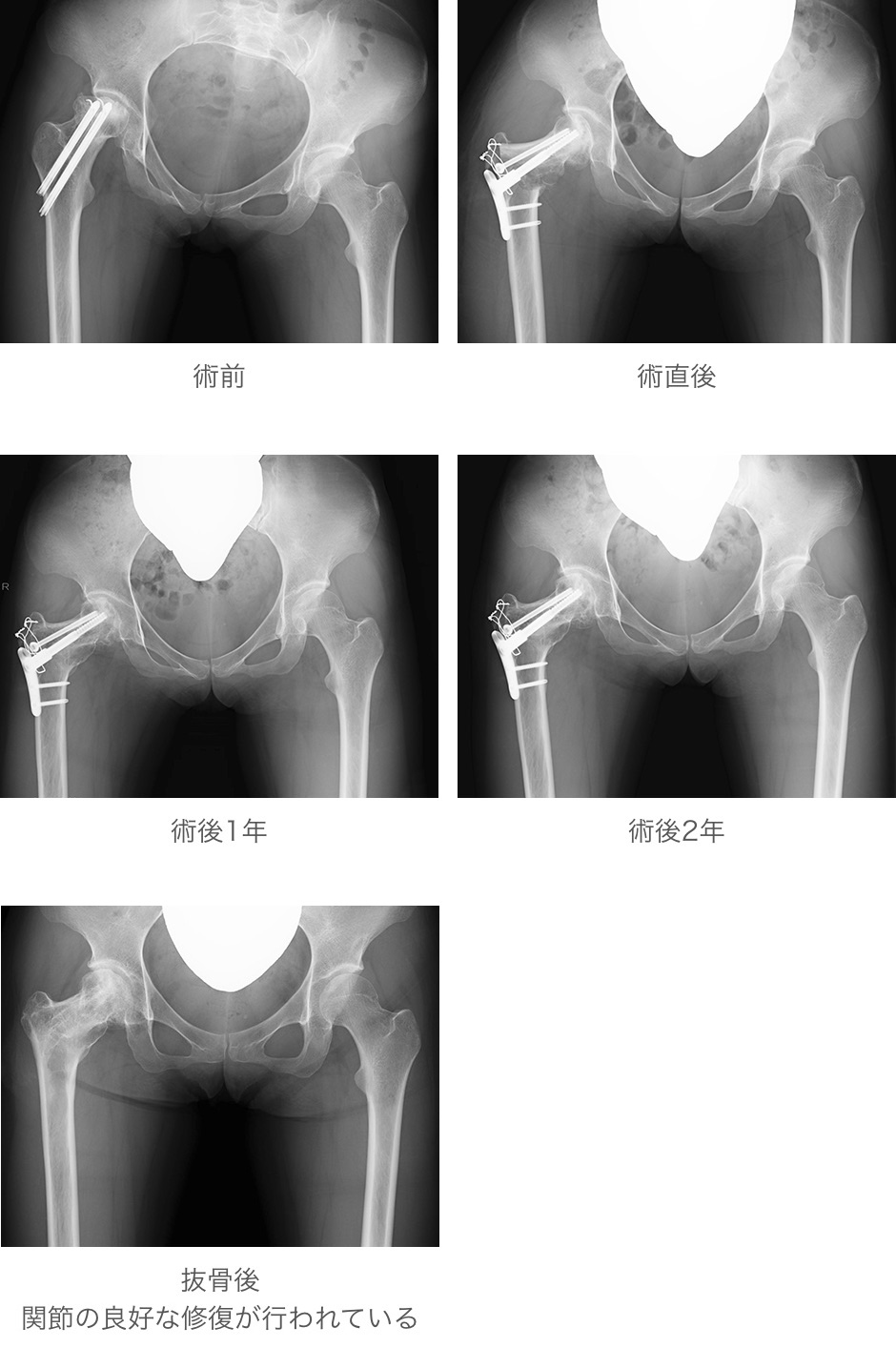 大腿骨頭回転骨切り術（外傷性大腿骨頭壊死に対して）