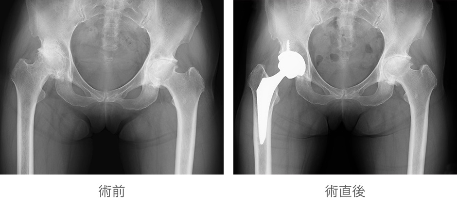 人工股関節置換術